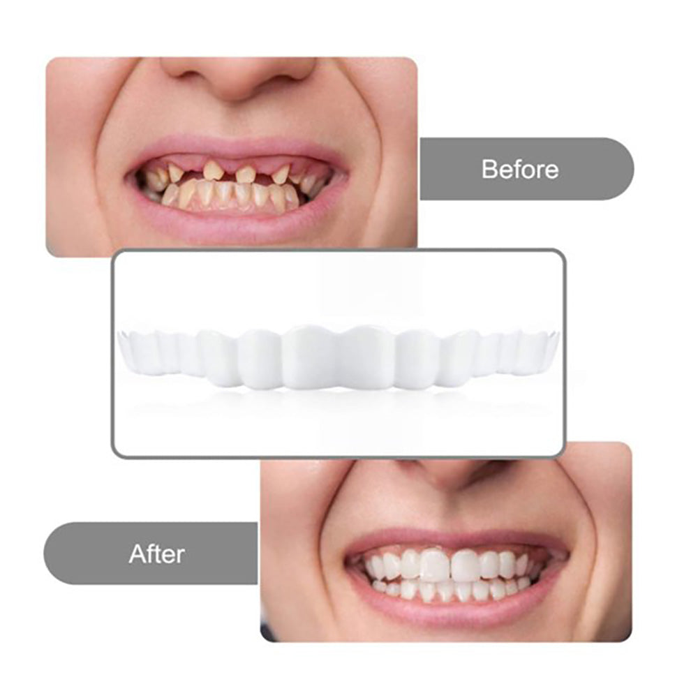 Teeth Veneers - Perfect Smile Upper & Lower Temporary Veneers for Instant Cosmetic Smile Enhancement
